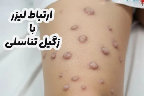 لیزر و زگیل تناسلی