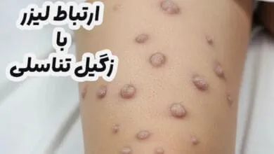 لیزر و زگیل تناسلی