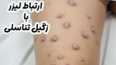 لیزر و زگیل تناسلی