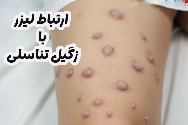 لیزر و زگیل تناسلی