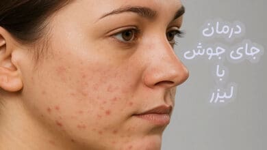 درمان جای جوش با لیزر