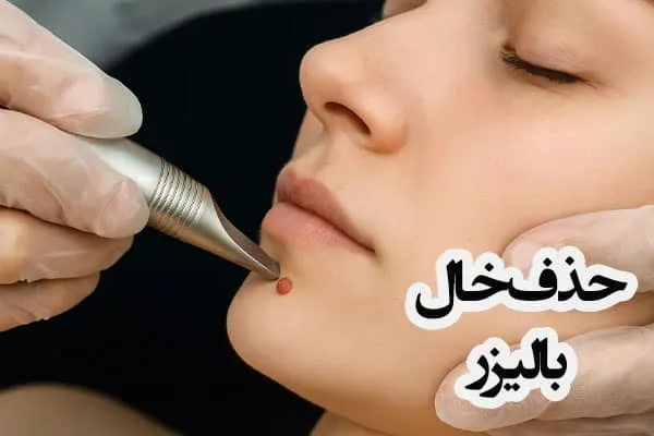 لیزر خال صورت