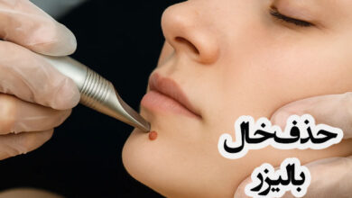 لیزر خال صورت