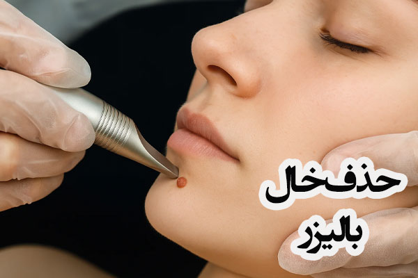 لیزر خال صورت