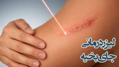 درمان جای بخیه با لیزر