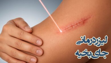 درمان جای بخیه با لیزر