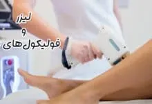تاثیر لیزر بر فولیکول