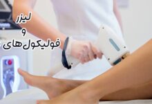تاثیر لیزر بر فولیکول